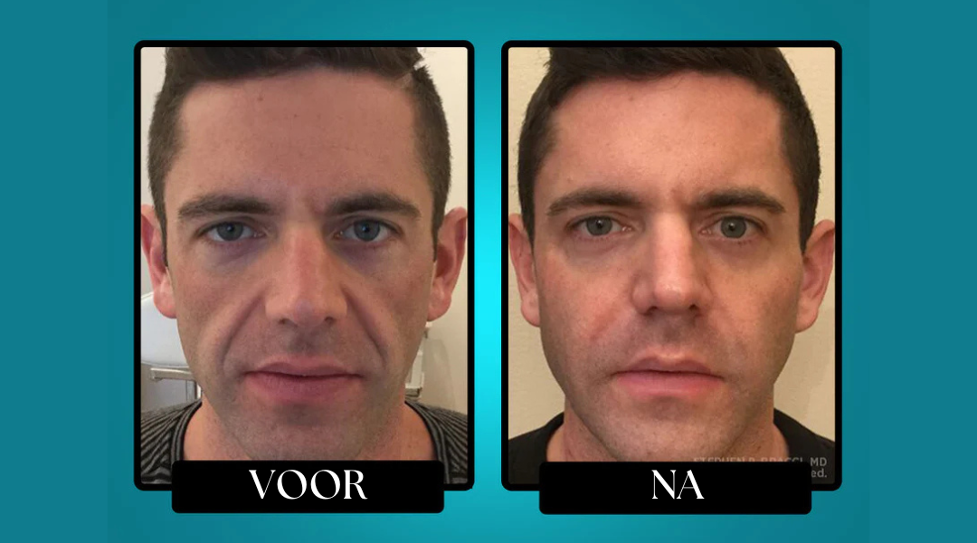 BIYORA™ Rimpelbescherming Tallow Balsem